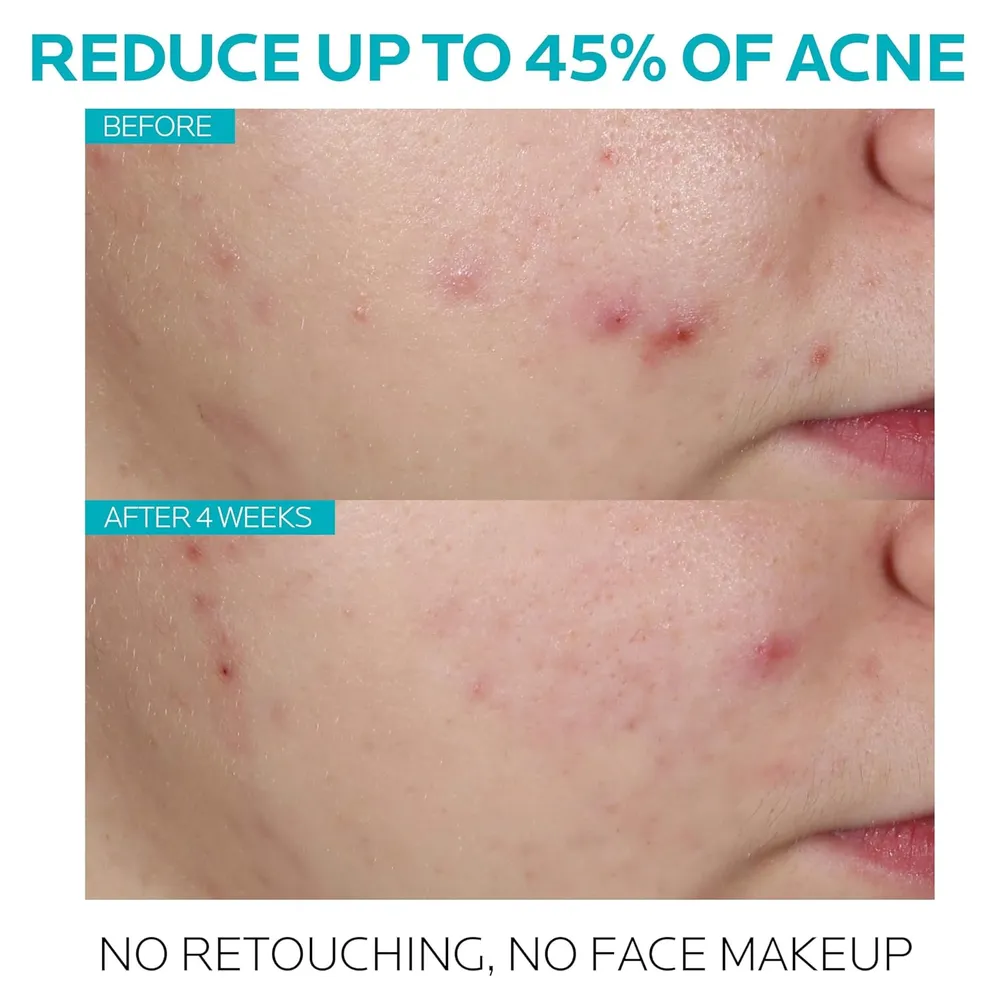 SET LA ROCHE-POSAY EFFACLAR ANTIACNÉ  ANTHELIOS UV SPF 50 - 40 ML +  EFFACLAR ÁCIDO SALICÍLICO 30 ML